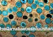 First Case of Monkeypox in Pakistan: WHO Declares Emergency Situation news-17082024-064854