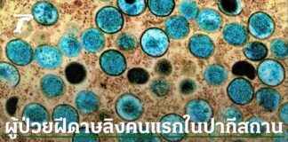 First Case of Monkeypox in Pakistan: WHO Declares Emergency Situation news-17082024-064854