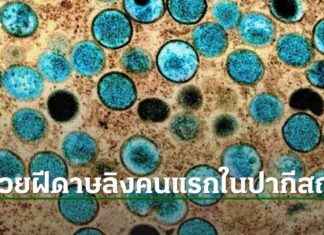 First Case of Monkeypox in Pakistan: WHO Declares Emergency Situation news-17082024-064854