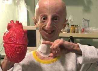 Survivor of Progeria Disease Passes Away at Age 28 news-06102024-162953